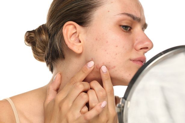 Mụn Cằm Lì, Lặp Đi Lặp Lại: Vì Sao Mãi Không Hết?